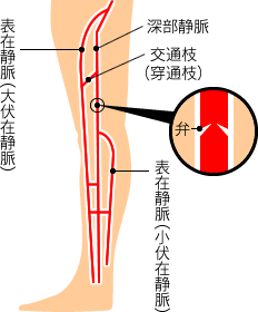 静脈瘤の原因