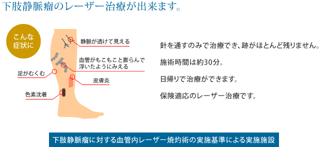 県下初！下肢静脈瘤のレーザー治療が出来ます。